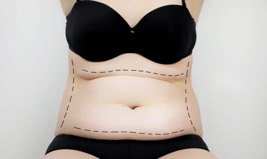 Une abdominoplastie est elle sans danger?